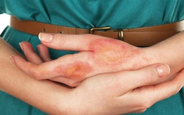 7 dấu hiệu bất thường trên da cho thấy đường huyết đang tăng cao, hãy can thiệp khẩn cấp để tránh các biến chứng nguy hiểm