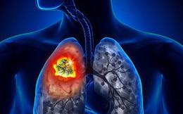 Bệnh nhân ung thư phổi giai đoạn cuối vẫn sống tiếp 10 năm: Bác sĩ khẳng định yếu tố quan trọng giúp đạt hiệu quả trong điều trị không chỉ có thuốc