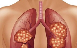 Ung thư phổi không ‘ngụy trang’ cũng không ‘tàng hình’: 1 THÔ, 1 TÊ, 1 ĐAU cảnh báo bệnh đang âm thầm tấn công cơ thể, dù chỉ có 1 biểu hiện cũng cần khám ngay