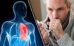 "1 chậm, 2 lồi, 3 thêm" trên cơ thể cảnh báo ung thư phổi: Tưởng bệnh vặt, không thăm khám sớm có thể làm bạn với máy thở cả đời