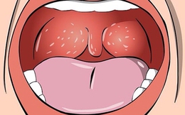 3 triệu chứng xuất hiện ở cổ họng ngầm cảnh báo phổi đang bị tổn thương, ngay từ điều đầu tiên đã rất đáng lo