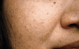 3 tín hiệu "không đau, không ngứa" trên khuôn mặt ngầm cho thấy gan đang bị tổn thương