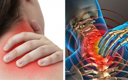 6 nguyên nhân hàng đầu gây đau vùng cổ