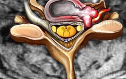 Cảnh báo: Ngồi sai tư thế có thể bị liệt, thoát vị đĩa đệm