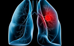 Dù không hút thuốc, chúng ta vẫn dễ mắc ung thư phổi bởi nguyên nhân khó tránh này