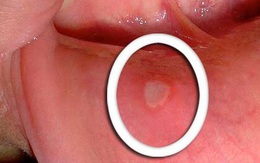 Đừng coi thường những vết loét trong miệng, đó có thể là dấu hiệu của 1 căn bệnh ung thư!