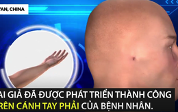 "Trồng" tai giả thành công trên cánh tay: Các bác sĩ sẽ tiến hành ghép vào đầu bệnh nhân