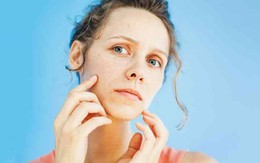 Những dấu hiệu trên gương mặt báo hiệu cơ thể đang thiếu vitamin và các dưỡng chất cần thiết