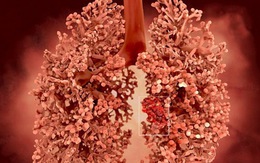8 dấu hiệu đầu tiên của ung thư phổi thường bị bỏ qua: Biết sớm để phòng nguy hiểm