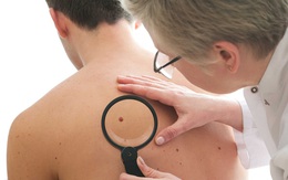 4 dấu hiệu cảnh báo ung thư da bạn tuyệt đối không được bỏ qua