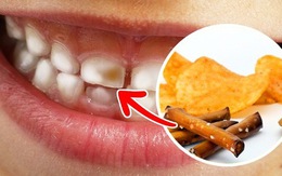 Nếu bạn vẫn làm những việc này hàng ngày thì đừng hỏi tại sao bị sâu răng, viêm lợi