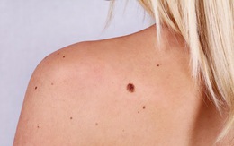 5 dấu hiệu bất thường ở nốt ruồi cảnh báo nguy cơ ung thư da