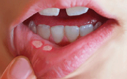 7 phương pháp đơn giản chữa nhiệt miệng, giảm ngay đau đớn và khó chịu