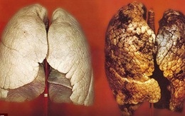 Ung thư phổi có tỷ lệ tử vong rất cao: 4 nhóm người cần đặc biệt chú ý đến việc khám phổi