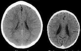 Đây là ảnh chụp não bộ của 2 đứa trẻ, đứa trẻ bên phải sẽ có một tương lai bất hạnh chỉ vì một hành động của phụ huynh
