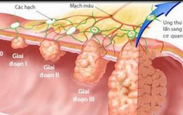 Chuyên gia Malaysia: 3 cách phát hiện sớm, loại bỏ ung thư đại trực tràng từ "trứng nước"