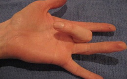 Tình trạng kỳ quặc này có thể khiến ngón tay bạn không hoạt động được