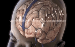 Hình ảnh cho thấy rung lắc gây tác hại đến não trẻ thế nào, dù chỉ 5 giây
