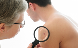 Nắng nóng gay gắt: Cảnh báo 2 dạng ung thư da ngày càng phổ biến bạn có nguy cơ mắc phải