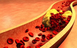 Công thức chữa bệnh cổ đại của người Đức thông mạch máu, giảm cholesterol trong 3 tuần