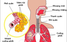 Để phòng và chữa bệnh nhiễm trùng đường hô hấp trên, bạn có thể làm 7 biện pháp này tại nhà