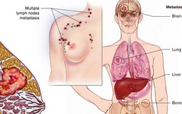 Ung thư vú không còn sợ di căn lên não, theo nghiên cứu từ ĐH California