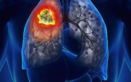 8 biểu hiện không ngờ tới của ung thư phổi: Hãy cảnh giác!