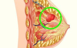 Uống nhiều sữa có gây ung thư? Đây là câu trả lời của Quỹ nghiên cứu Ung thư thế giới