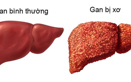 5 dấu hiệu của bệnh xơ gan ai đã có thì nên khám ngay kẻo muộn