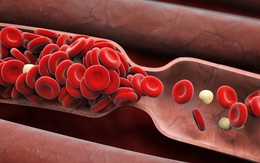 6 dấu hiệu cảnh báo có cục máu đông trong cơ thể mà bạn không được phép bỏ qua