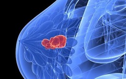 Nguyên PGĐ Bệnh viện K chỉ rõ 4 nguyên nhân gây 80% trường hợp ung thư vú