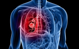 Vitamin B có thể làm tăng nguy cơ ung thư phổi ở nam giới