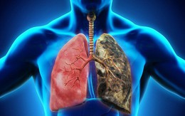 Vì sao số người mắc ung thư phổi ngày càng tăng? Chuyên gia cảnh báo nguyên nhân là thứ chúng ta đang tiếp xúc hàng ngày
