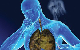 Ung thư phổi tiên lượng xấu nếu phát hiện muộn: Chỉ cần có dấu hiệu này là phải khám ngay!