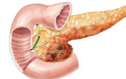 Sốt, đau bụng đi kèm các dấu hiệu này: Hãy cảnh giác cao độ với bệnh ung thư tuyến tụy