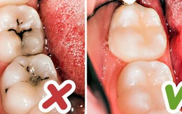 8 mẹo vặt hữu ích giúp bạn luôn nói không với bệnh sâu răng