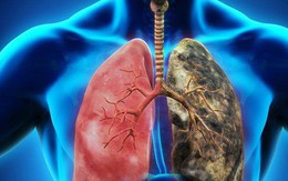 Dấu hiệu điển hình của ung thư phổi: Biết sớm để giành lại cơ hội sống cao nhất là 49%