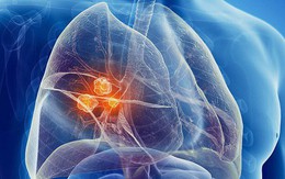 Ung thư phổi đang đứng đầu về tỉ lệ tử vong: Đây là nguyên nhân, dấu hiệu đừng nên bỏ qua