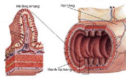 “Chìa khóa vàng” giúp cải thiện viêm đại tràng hiệu quả