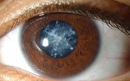 4 căn bệnh ở mắt nếu không chữa trị sớm có thể dẫn tới nguy cơ mù lòa
