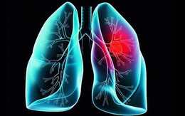 Khi bị ho, sốt và 3 dấu hiệu đi kèm cùng lúc, cẩn thận ung thư phổi đã vào giai đoạn nặng