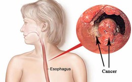 Âm thầm rước "án tử" vào đường tiêu hóa vì thói quen gần như ai cũng mắc phải