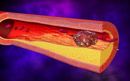 Cách phòng ngừa 90% nguy cơ đột quỵ từ chuyên gia