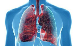 Người có 6 thói quen này có tỉ lệ mắc ung thư phổi rất cao: Hãy xem có bạn không để tránh!