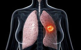 Bị ung thư phổi có thể sống được bao lâu: Bạn nên biết điều này để phòng bệnh hiệu quả