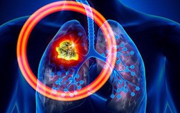 Xu hướng người trẻ tuổi mắc ung thư phổi đang tăng nhanh: Làm sao để phát hiện sớm nhất?