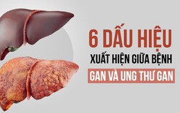 6 dấu hiệu cảnh báo khi bệnh gan tiến triển thành ung thư: Phát hiện sớm là rất quan trọng