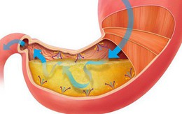 3 loại nước sẽ khiến bệnh dạ dày trở nên trầm trọng: Có thể bạn đang uống mà không biết!