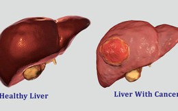5 yếu tố lớn nhất có nhiều khả năng gây ung thư gan: Dù bạn ở lứa tuổi nào cũng nên tránh