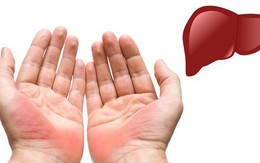 7 biểu hiện ở đôi tay tiết lộ các bệnh mà cơ thể đang mắc, dấu hiệu đầu tiên cảnh báo bạn đang bị bệnh gan đấy